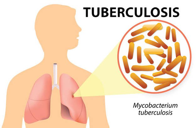 shtf diseases tuberculosis