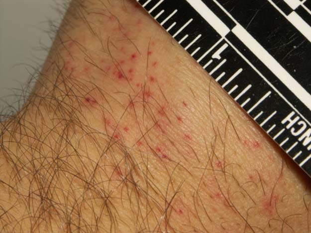 Evidence of bedbug bites on human skin (Image via)