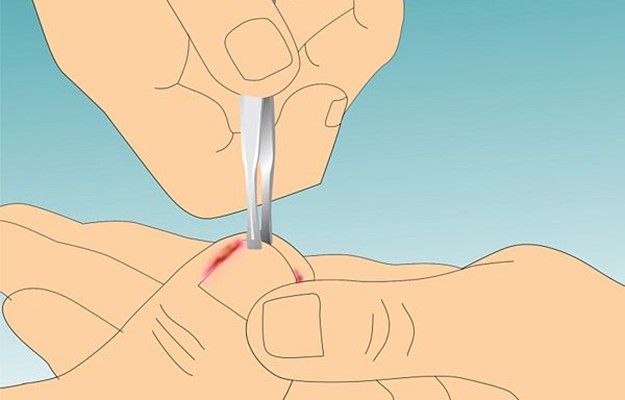 ingrown toe nail