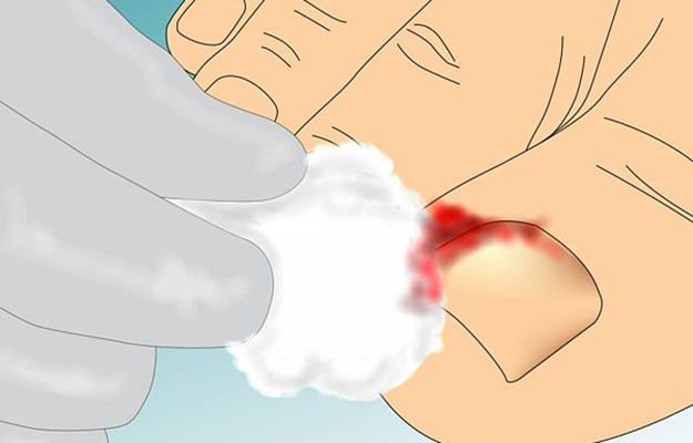 ingrown toenail home remedies