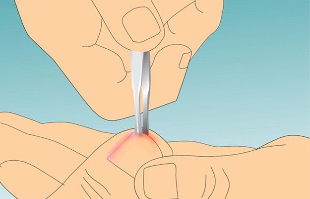 ingrown toenail home treatment