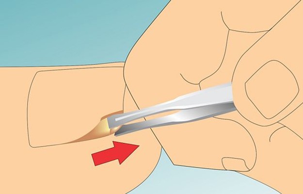 ingrown toenail treatment