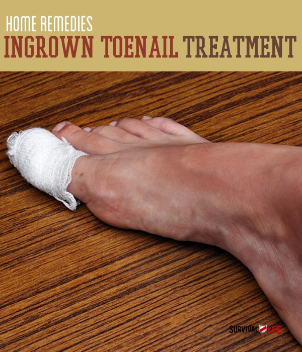 ingrown-toenail-treatment