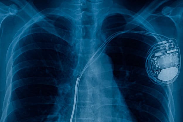Pacemakers shut down. | EMP Incoming! | What to Expect from an EMP