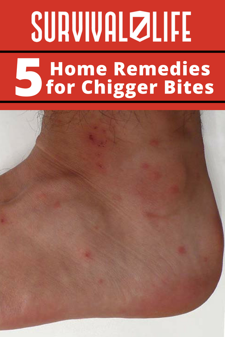 Home Remedies For Chigger Bites | https://survivallife.com/5-home-remedies-for-chigger-bites/