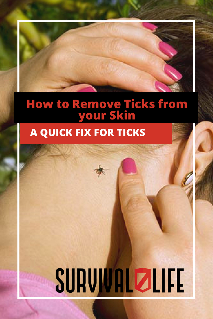 Placard | How to Remove Ticks from your Skin | Ticks