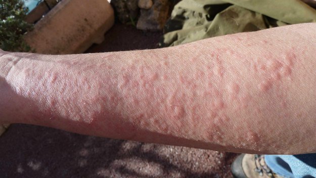 Wilderness Emergency Medicine | In-The-Field First Aid In A Pinch allergic reaction