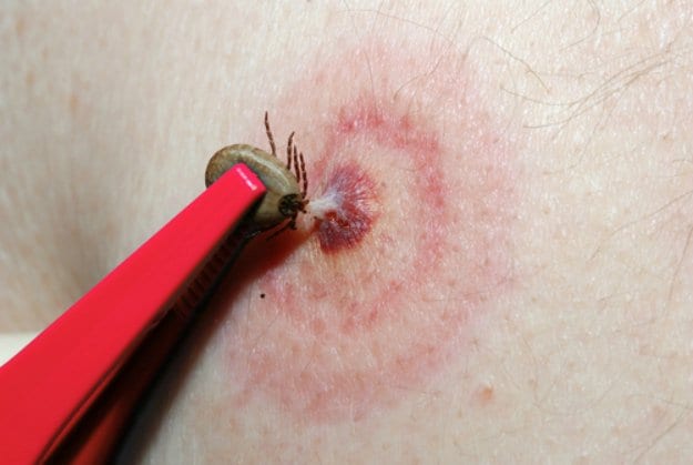 Remove Ticks | Rubbing Alcohol Survival Uses You Need To Know