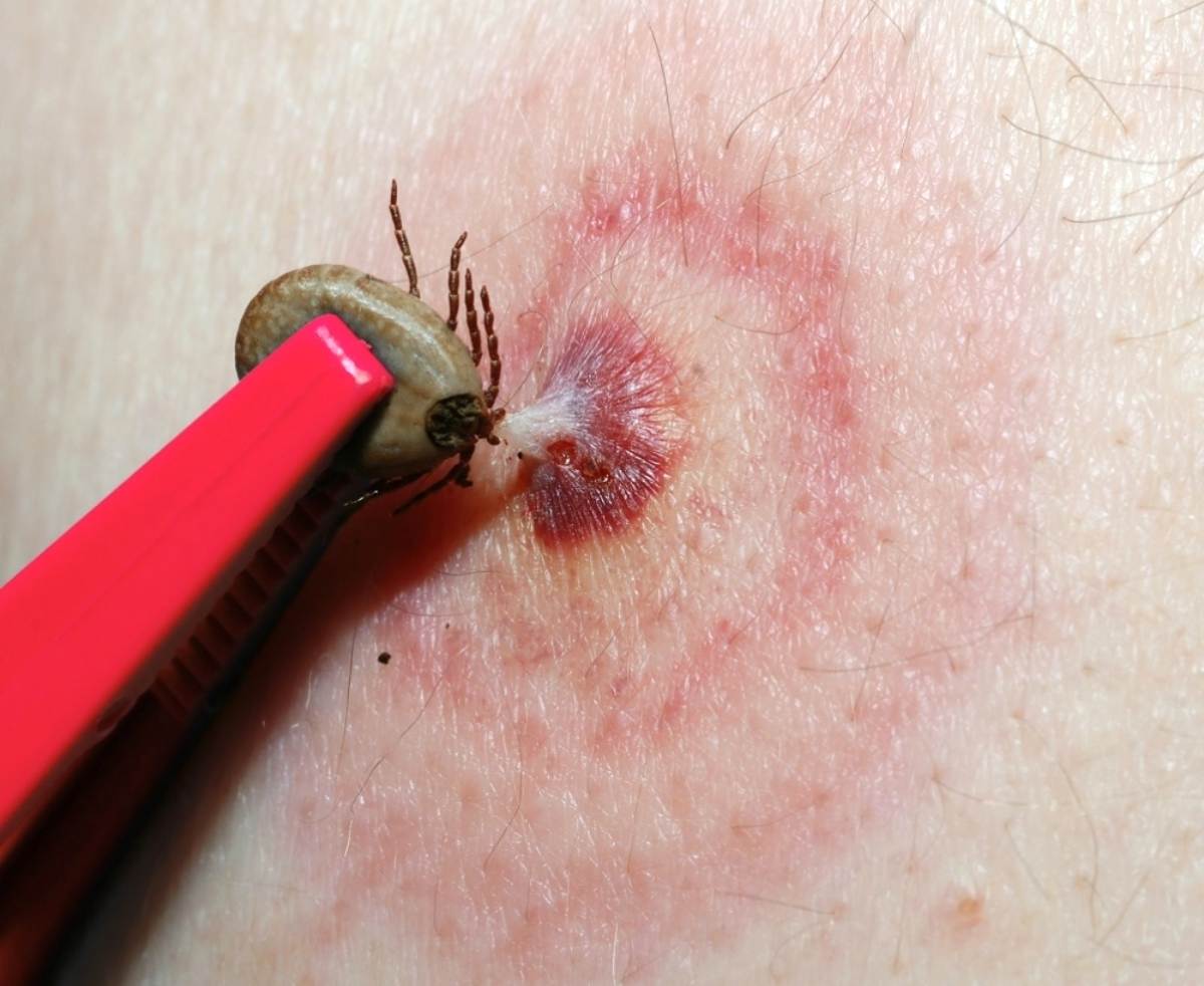Removing ticks using red tweezers | Rubbing Alcohol Survival Uses You Need To Know