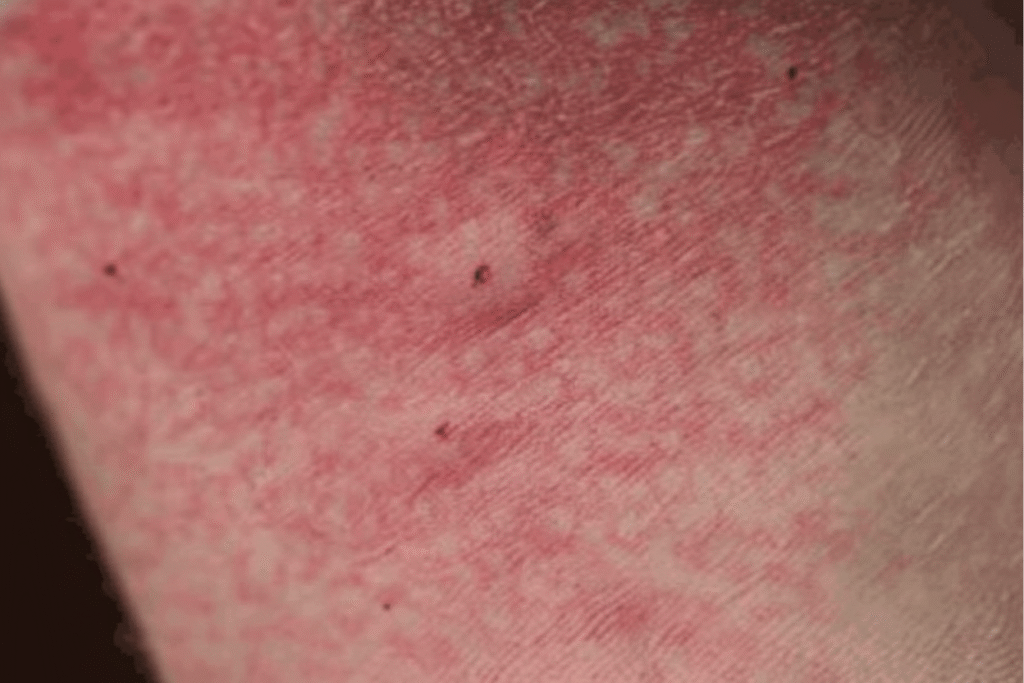 Spider Bites? Here's How To Treat It Spider Bites