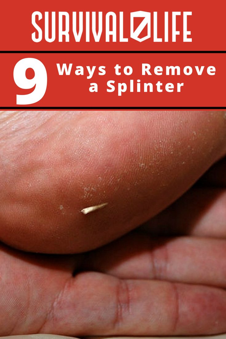 Ways To Remove A Splinter | https://survivallife.com/9-ways-to-remove-a-splinter/