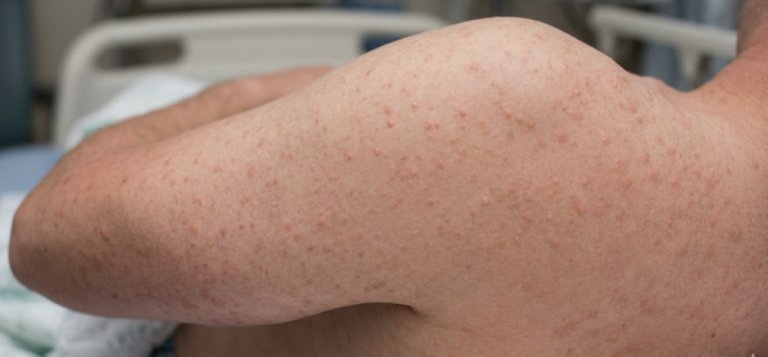 measles outbreak